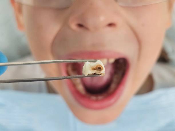 Best Broken or Chipped Tooth Repair in Wesley Chapel, FL